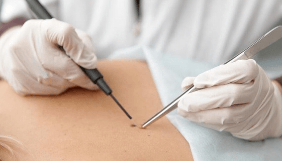 Characteristics of the elimination of papilloma