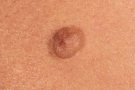 Simple papilloma