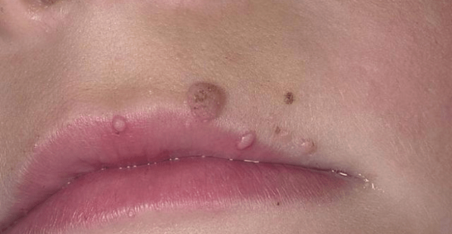 Lip papillomas