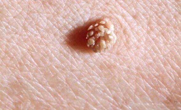 Papilloma on the human body