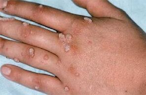 human papilloma virus treatment