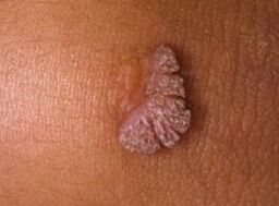 human papilloma virus, what is it