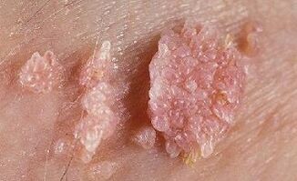 photo of human papilloma virus