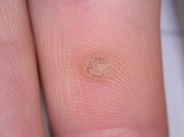 can warts cause cancer