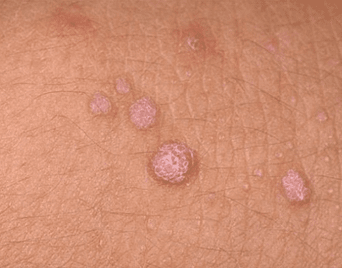flat warts on the body